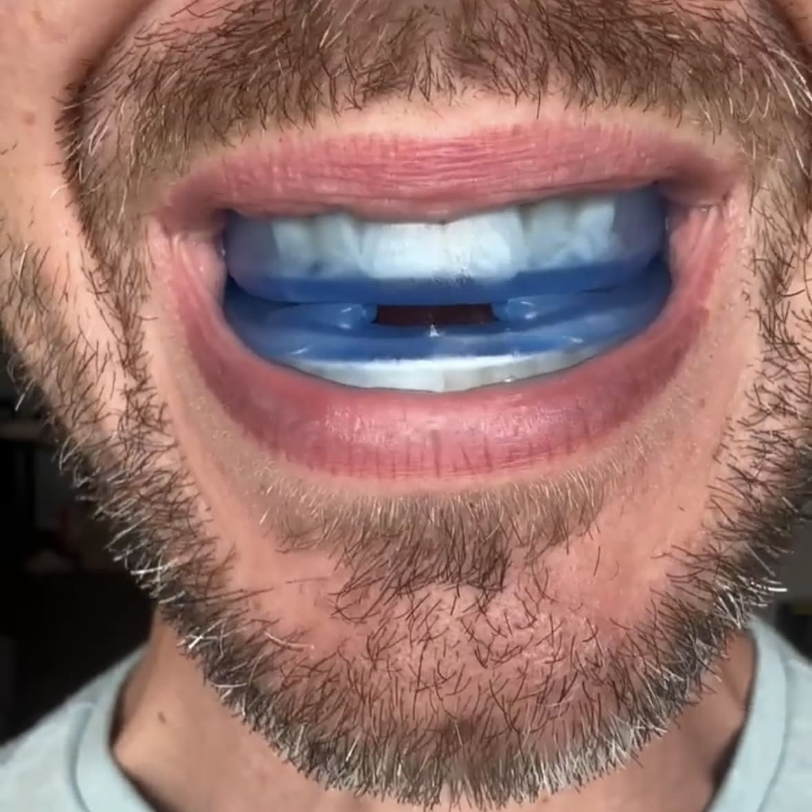 Buy 1 Get 1 Free - The Quiet Anti-Snoring Mouthpiece Universal Size